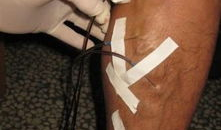 静脉曲张放血视频